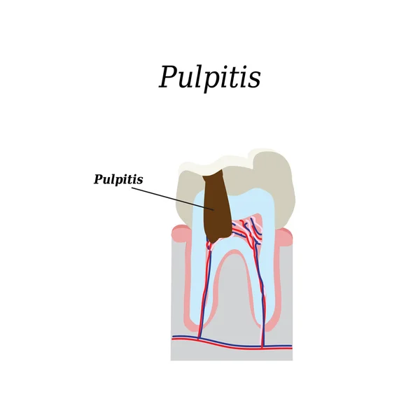 Polpa dentale. Illustrazione vettoriale su sfondo isolato — Vettoriale Stock