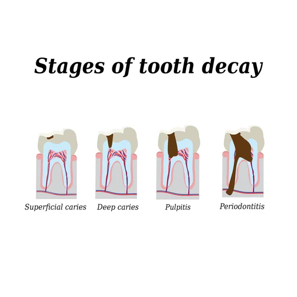 Stages of development of dental caries. Vector illustration on isolated background — Stock Vector
