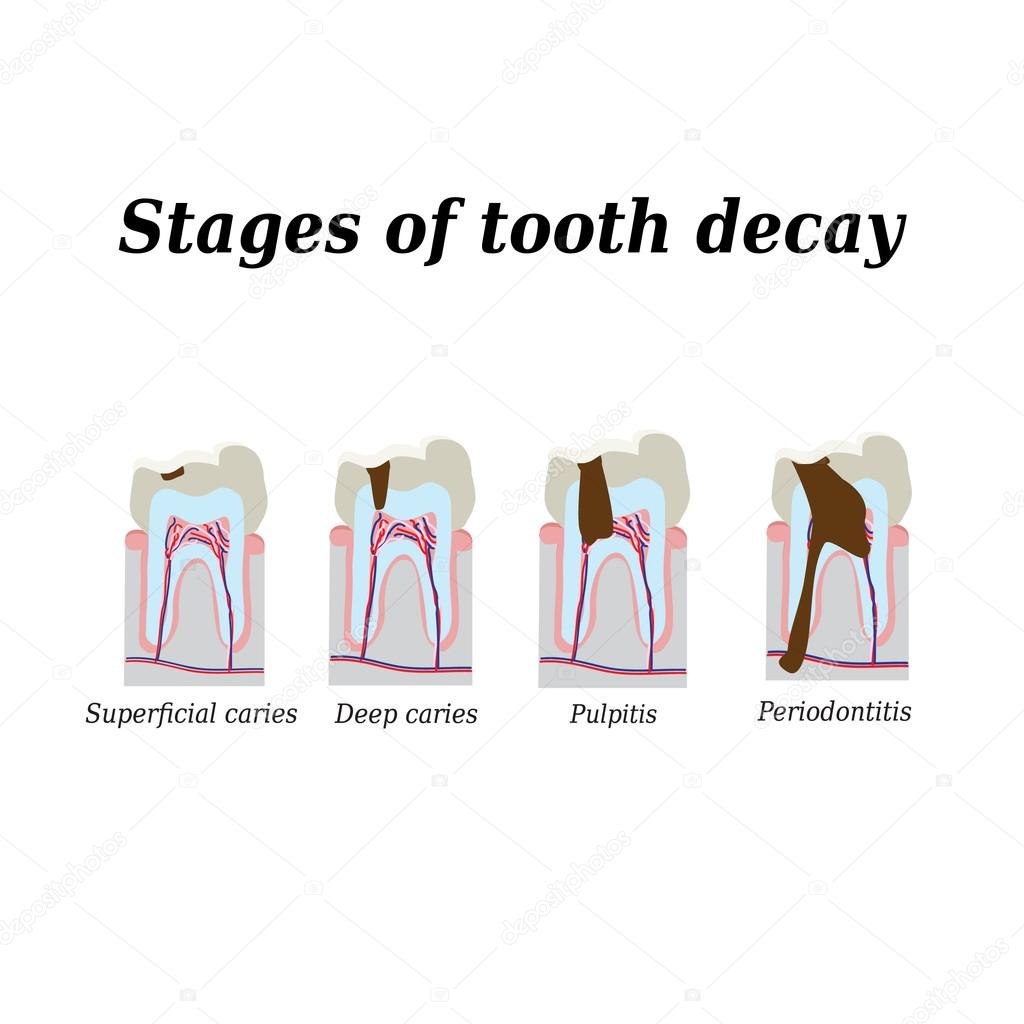 Stages of development of dental caries. Vector illustration on isolated background
