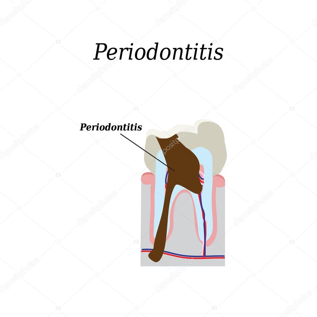 Periodontitis tooth. Vector illustration on isolated background