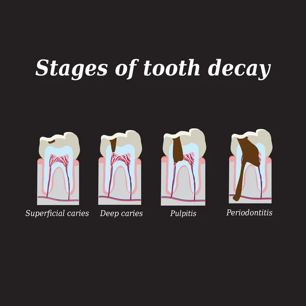 Stages of development of dental caries. Vector illustration on a black background — Stock Vector