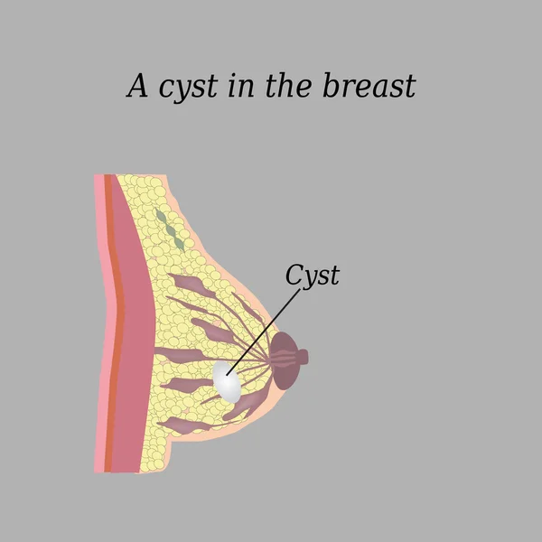 A cyst in the breast. On a gray background. The structure of the breast. Mammary gland — Stock Vector