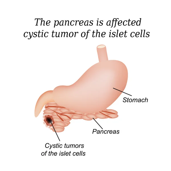 El páncreas es un tumor quístico afectado de las células de los islotes. Ilustración vectorial sobre fondo aislado — Vector de stock