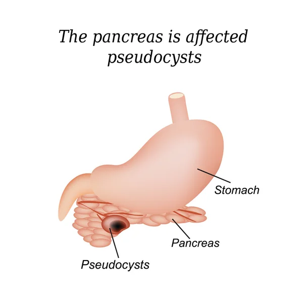 Pseudocyst panreas terpengaruh. Ilustrasi vektor pada latar belakang terisolasi - Stok Vektor