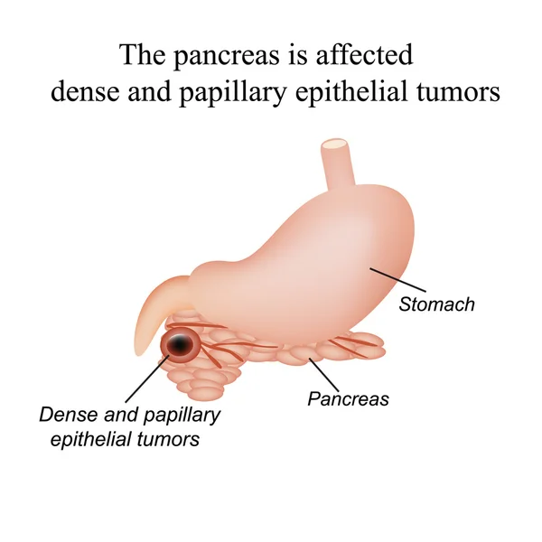 El páncreas está afectado por tumores epiteliales densos y papilares. Ilustración vectorial sobre fondo aislado — Vector de stock