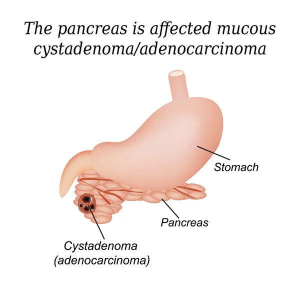 Cistadenoma mucoso do pâncreas, adenocarcinoma. Ilustração vetorial sobre fundo isolado — Vetor de Stock