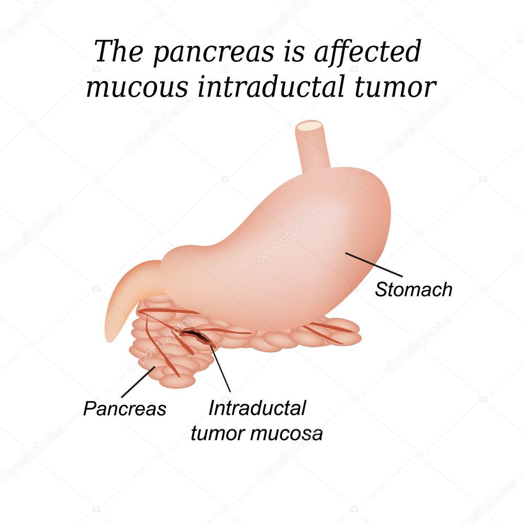 The pancreas is affected mucous intraductal tumor. Vector illustration on isolated background