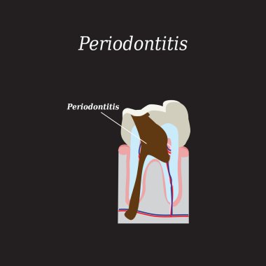 Periodontitis dişlerin var. Vektör çizim siyah bir zemin üzerine