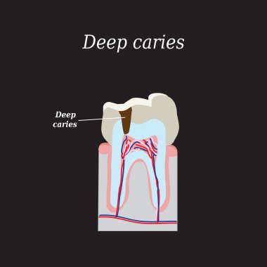 Deep tooth decay. Vector illustration on a black background clipart