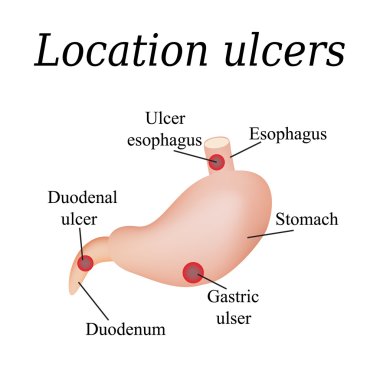 Esophagus ulcer affected. Ulcer of esophagus. Stomach ulcer affected. Gastric ulcer. Duodenum ulcer affected. Duodenal ulcer. Vector illustration on a background of isolation clipart