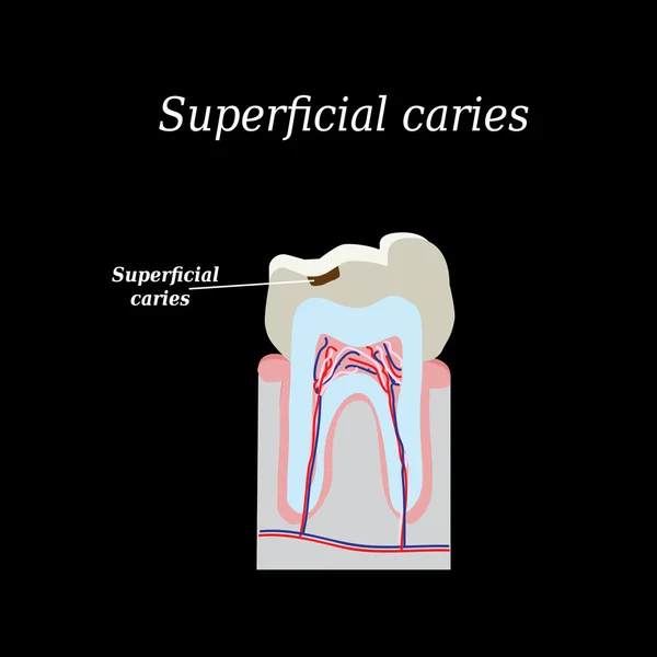Types of dental caries. Infographics. Vector illustration on isolated