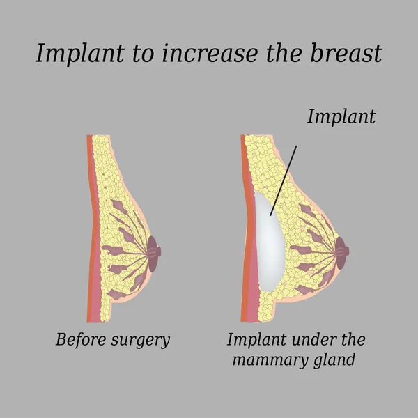 Implantát v prsu na šedém pozadí — Stockový vektor