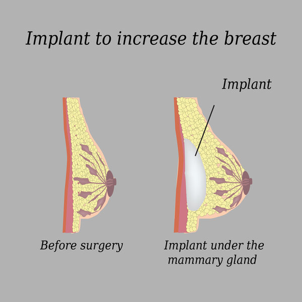The implant in the breast on a gray background