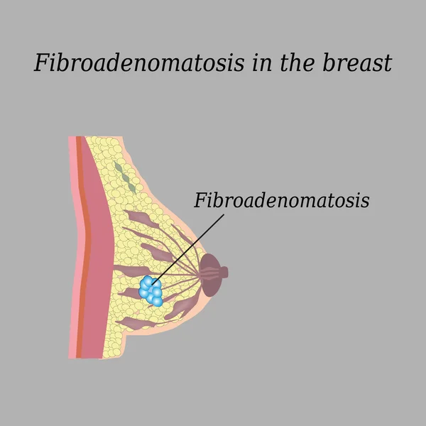 Fibroadenomatosis torácica. Sobre un fondo gris. La estructura de la mama. Glándula mamaria — Vector de stock