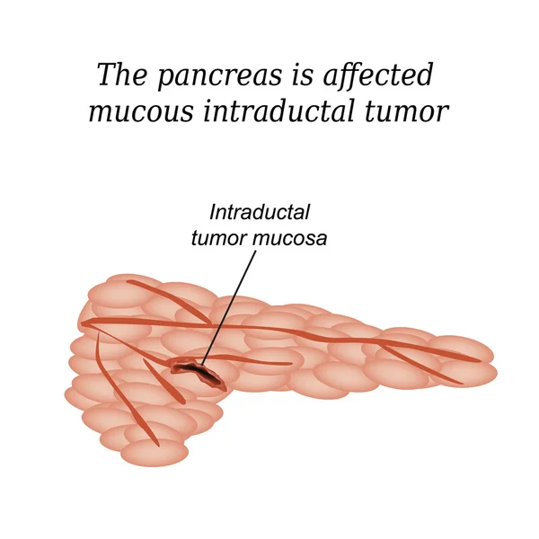 Il pancreas è colpito da tumore intraduttale mucoso. Illustrazione vettoriale su sfondo isolato — Vettoriale Stock