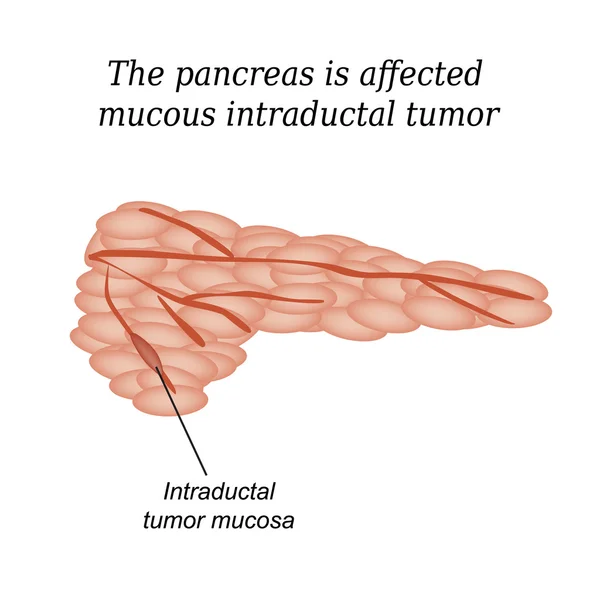 Il pancreas è colpito da tumore intraduttale mucoso. Illustrazione vettoriale su sfondo isolato — Vettoriale Stock