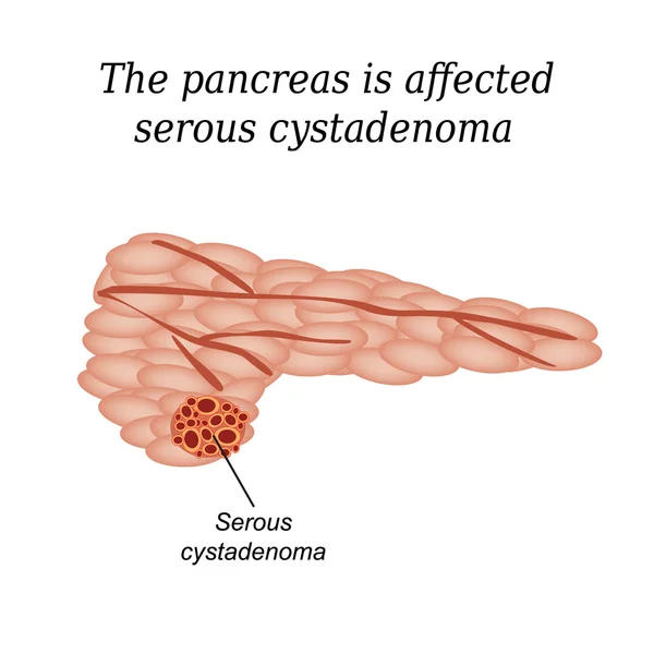 El páncreas está afectado por el cistadenoma seroso. Ilustración vectorial sobre fondo aislado — Vector de stock