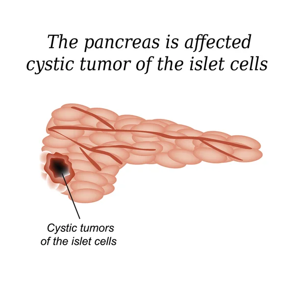 O pâncreas é um tumor cístico afetado das células ilhotas. Ilustração vetorial sobre fundo isolado — Vetor de Stock