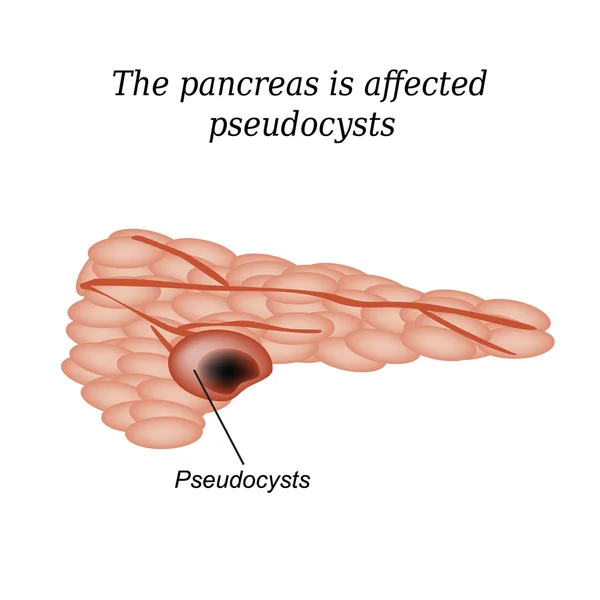 Pseudoquiste del páncreas afectado. Ilustración vectorial sobre fondo aislado — Archivo Imágenes Vectoriales