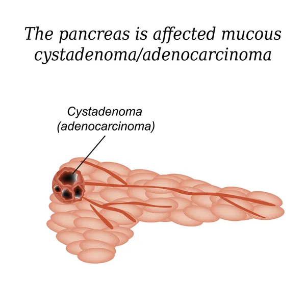 Cistadenoma mucoso do pâncreas, adenocarcinoma. Ilustração vetorial sobre fundo isolado — Vetor de Stock