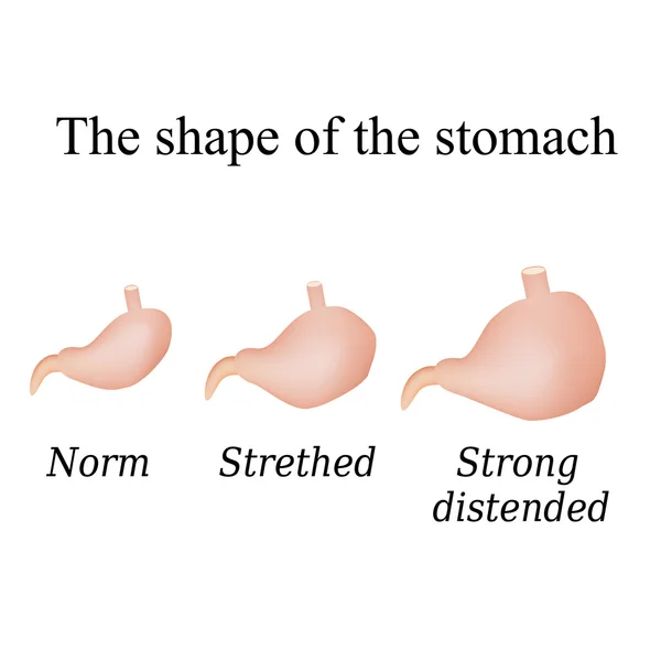 Différentes formes de l'estomac. Illustration vectorielle sur fond isolé — Image vectorielle