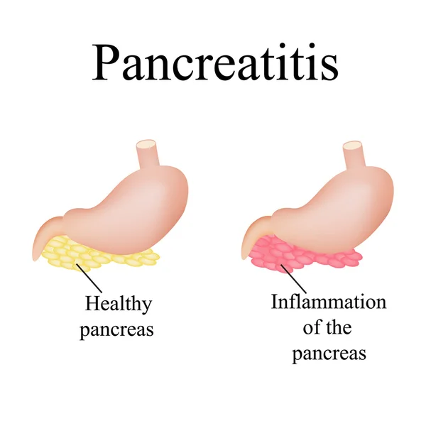 Zánět slinivky břišní. Pankreatitida. Vektorové ilustrace na izolované pozadí — Stockový vektor