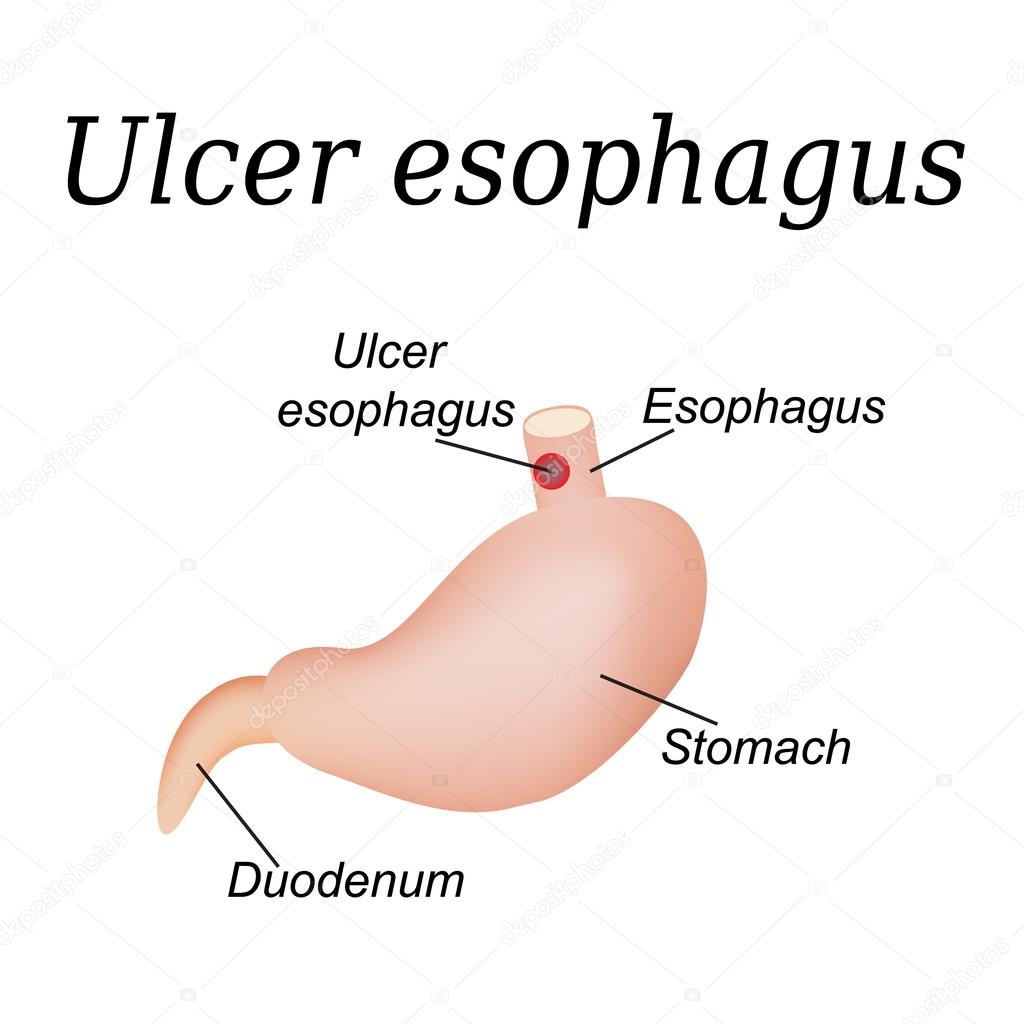 Esophagus ulcer affected. Ulcer of esophagus. Vector illustration on isolated background