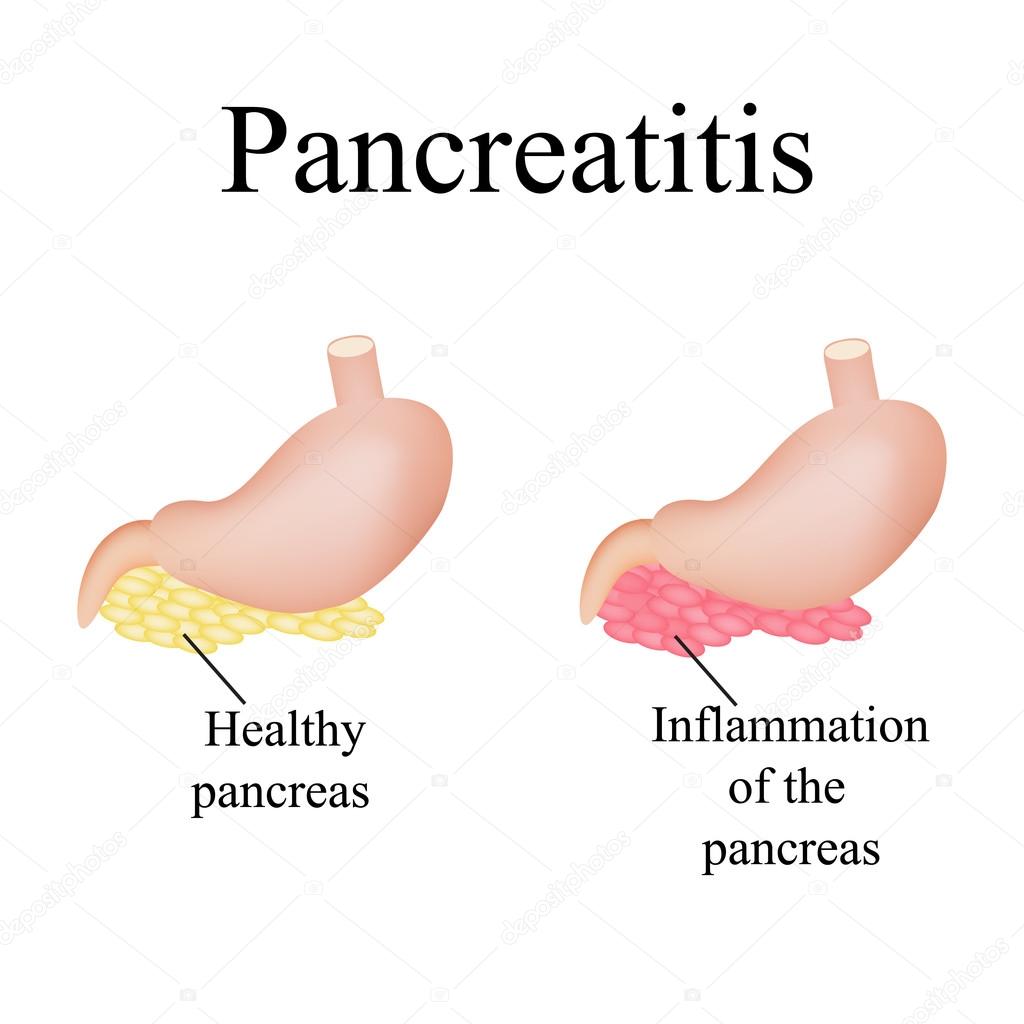 Inflammation of the pancreas. Pancreatitis. Vector illustration on isolated background