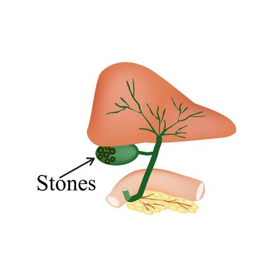 The stones in the gallbladder. Duodenum, pancreas, bile ducts. Vector illustration on isolated background clipart