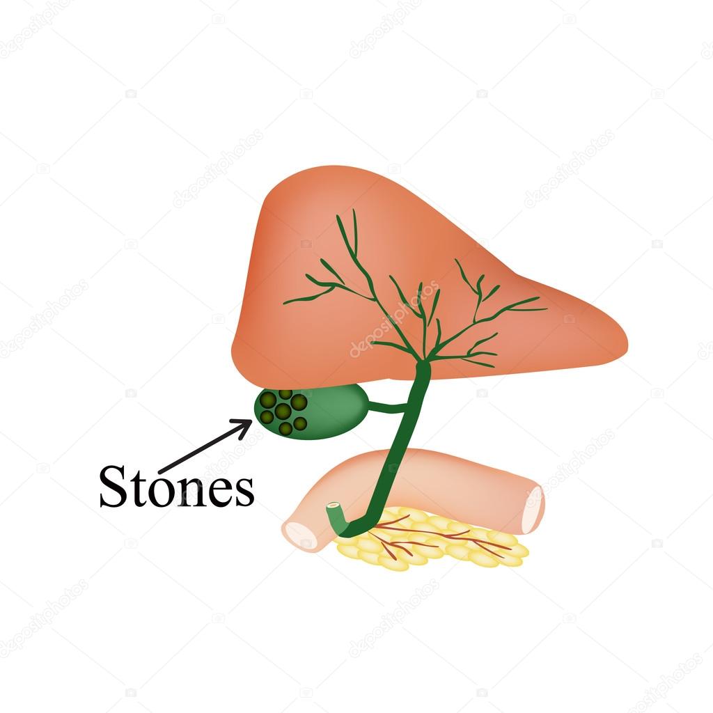 The stones in the gallbladder. Duodenum, pancreas, bile ducts. Vector illustration on isolated background