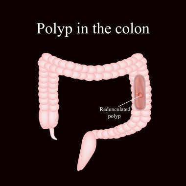 Polyp in the intestine. Polyp in the colon. Vector illustration on a black background clipart