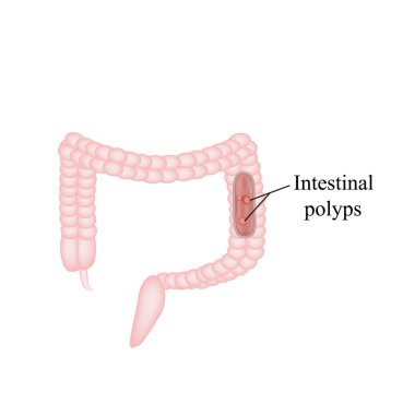 Polyp in the intestine. Polyp in the colon. Vector illustration on isolated background clipart
