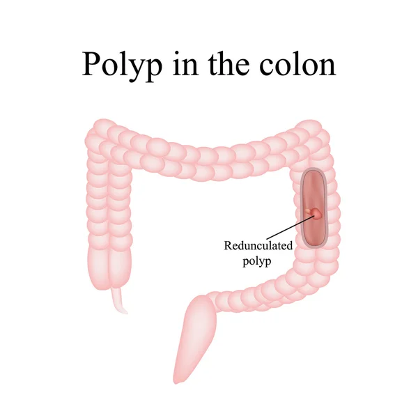 Pólipo en el intestino. Pólipo en el colon. Ilustración vectorial sobre fondo aislado — Vector de stock