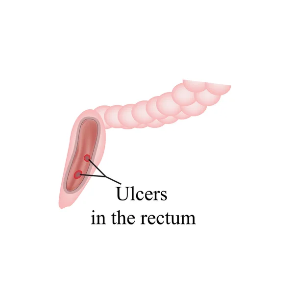 Una úlcera en el recto. Úlceras en los intestinos. Ilustración vectorial sobre el aislamiento — Vector de stock