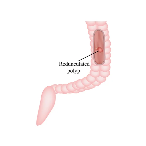 Pólipo en el intestino. Pólipo en el colon. Ilustración vectorial sobre fondo aislado — Vector de stock