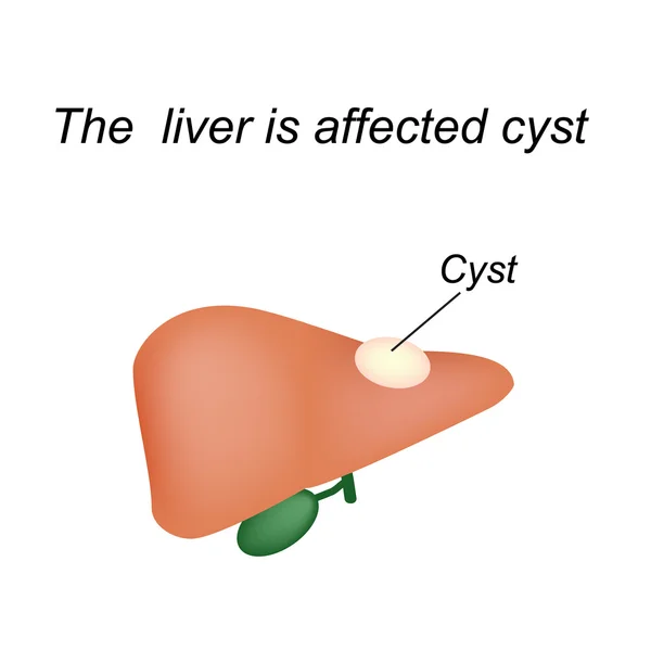 En cysta i levern. Levern är drabbade cysta. Vektor illustration på isolerade bakgrund — Stock vektor