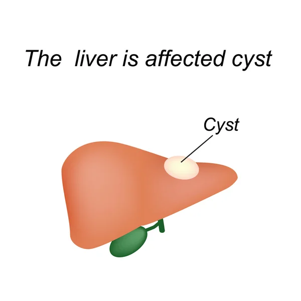 Quiste en el hígado. El hígado está afectado quiste. Ilustración vectorial sobre fondo aislado — Archivo Imágenes Vectoriales