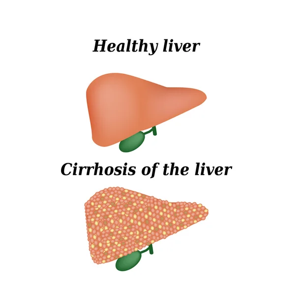 Cirrhosis a máj. Elszigetelt háttér vektor illusztráció — Stock Vector