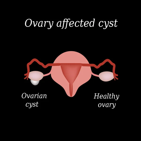 A cyst in the ovary. Pelvic organs. Vector illustration on a black background — Stock Vector