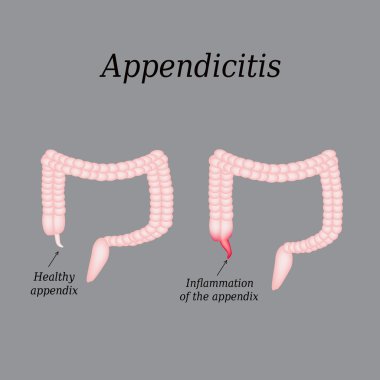 Appendicitis. Inflammation of the appendix. Colon. The illustration on a gray background clipart