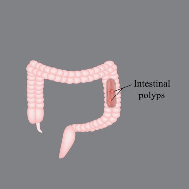 Polyp in the intestine. Polyp in the colon. Vector illustration on a gray background clipart