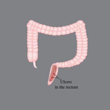 An ulcer in the rectum. Ulcers in the intestines. Vector illustration on a gray background clipart