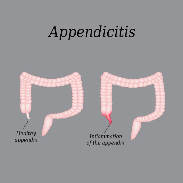 Appendicite. Infiammazione dell'appendice. Colon. L'illustrazione su sfondo grigio — Vettoriale Stock