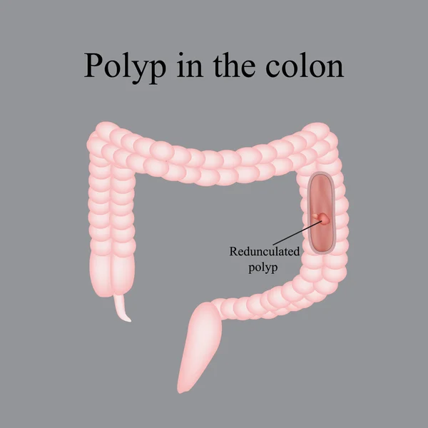 Pólipo en el intestino. Pólipo en el colon. Ilustración vectorial sobre fondo gris — Vector de stock