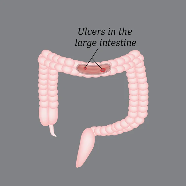 Úlcera en el intestino. Úlceras en el colon. Ilustración vectorial sobre fondo gris — Vector de stock