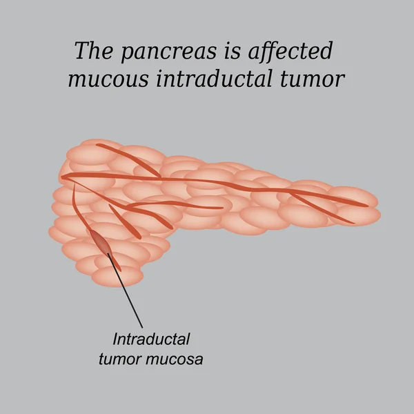 The pancreas is affected mucous intraductal tumor. Vector illustration on a gray background — Stock Vector