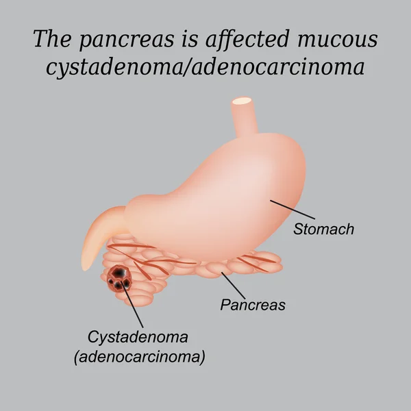 Cistadenoma mucoso do pâncreas, adenocarcinoma. Ilustração vetorial sobre fundo cinzento — Vetor de Stock