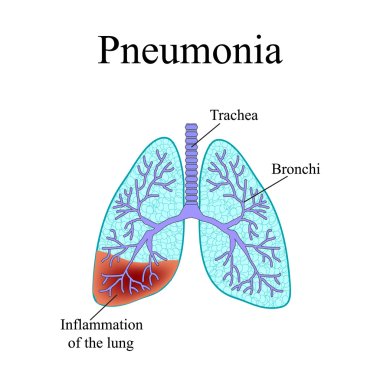 Pneumonia. The anatomical structure of the human lung. Vector illustration on isolated background clipart
