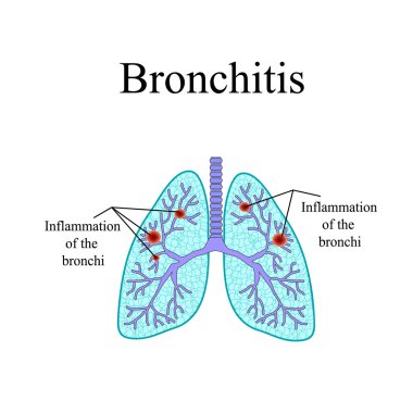 Bronşit. İnsan akciğer anatomik yapısı. Vektör illüstrasyon izole arka plan üzerinde