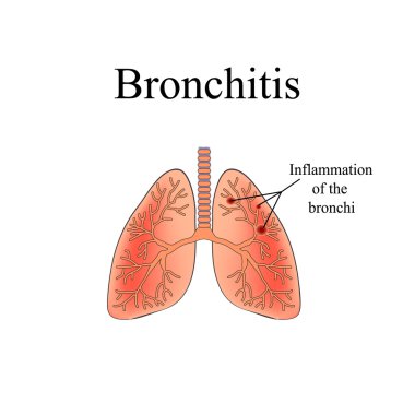 Bronşit. İnsan akciğer anatomik yapısı. Vektör illüstrasyon izole arka plan üzerinde